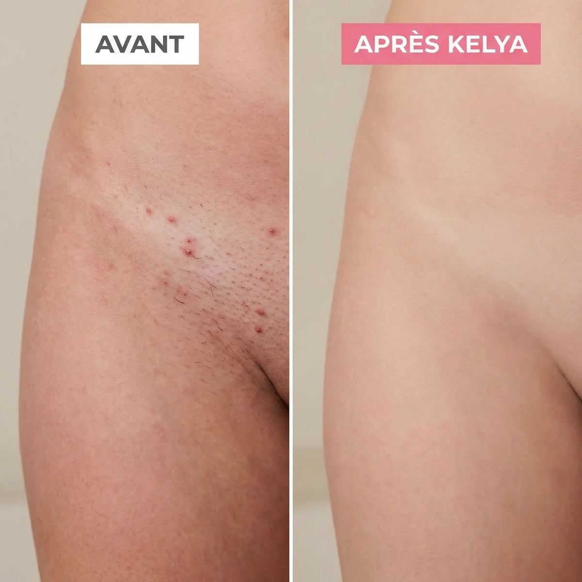 Rasoir 2-en-1 Kelya pour peaux sensibles, image montrant avant et après l'utilisation sur la zone du maillot.